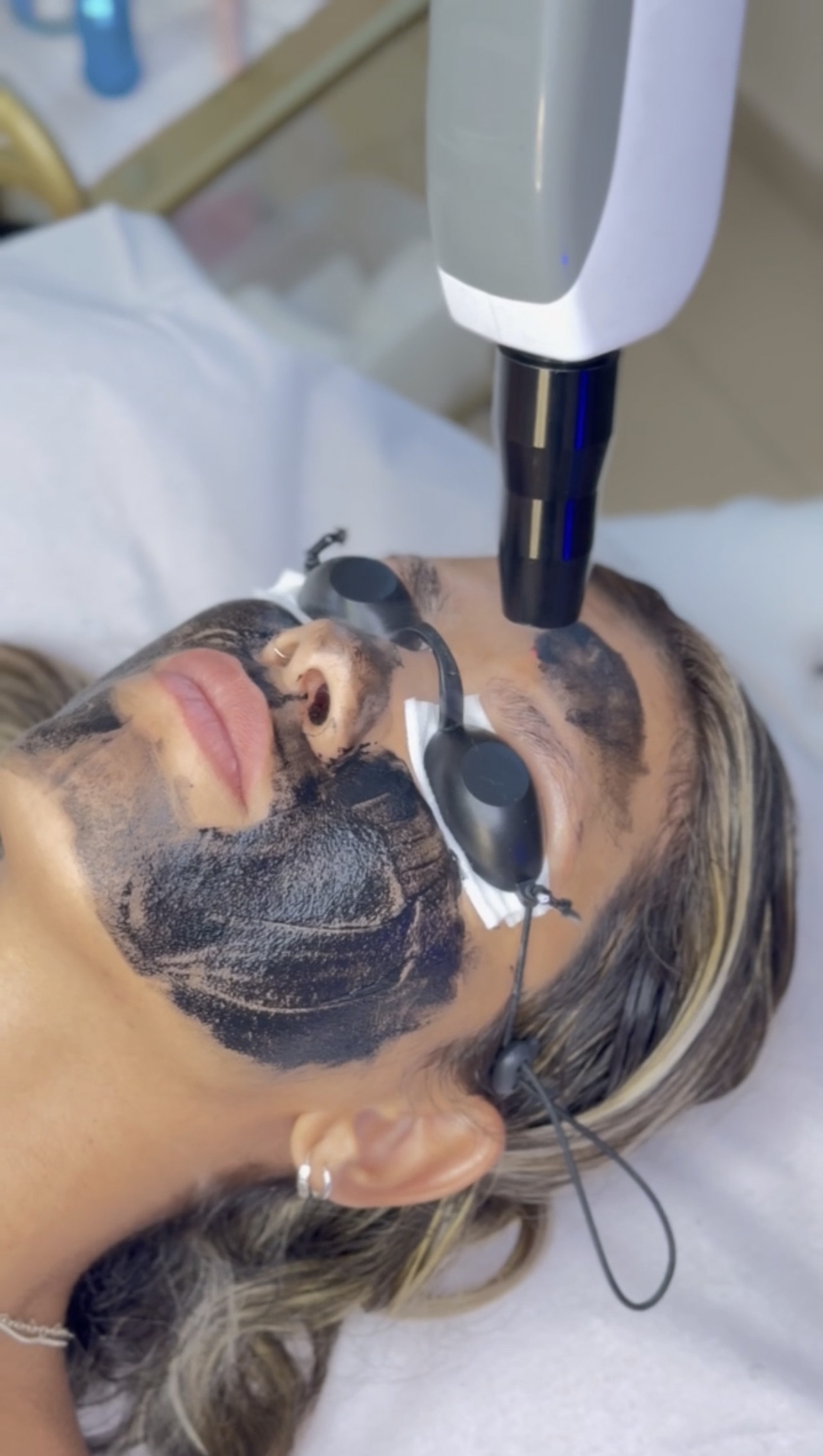 Procedimento Peeling de Hollywood