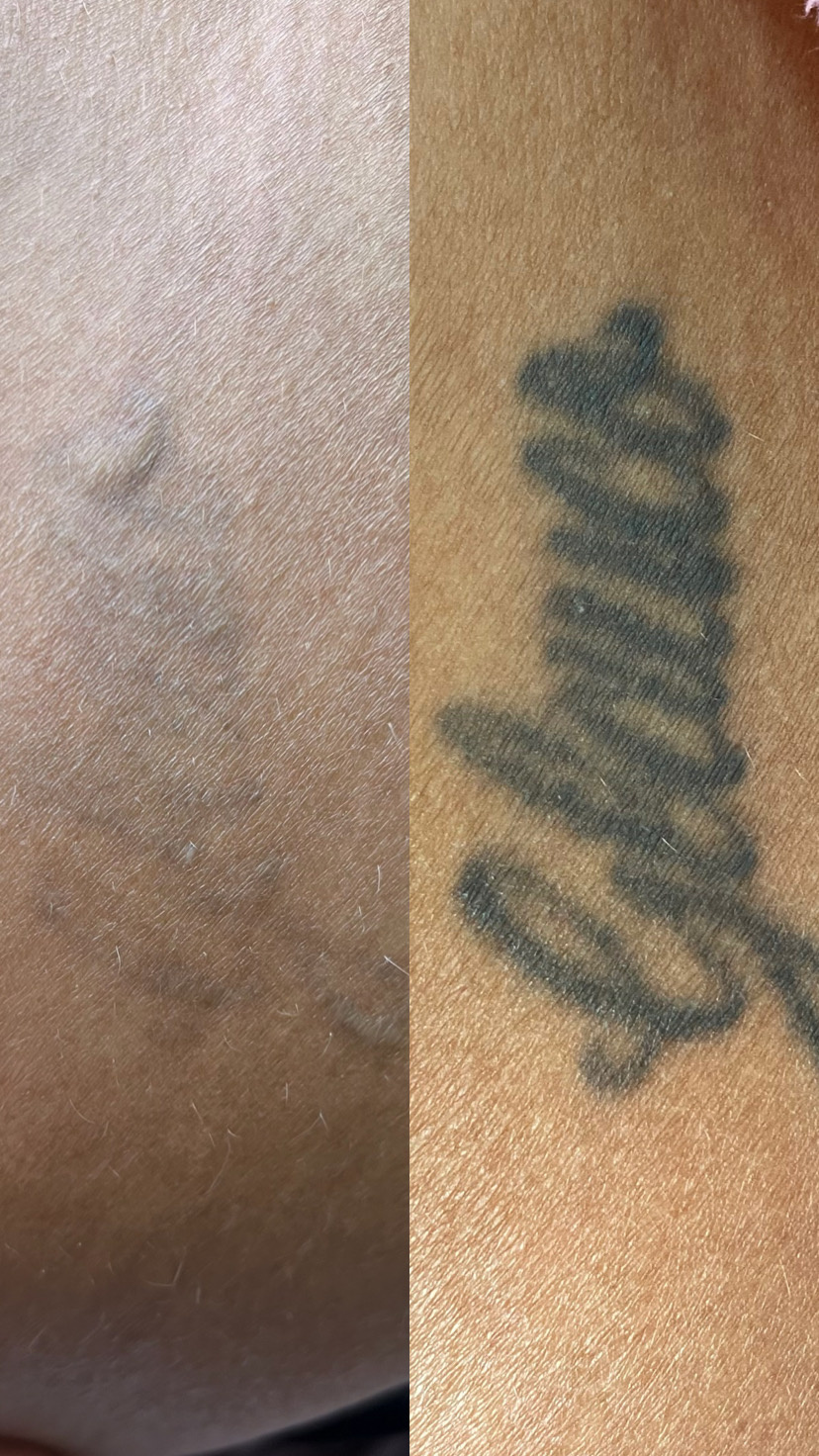 Procedimento de Remoção de Tatuagem